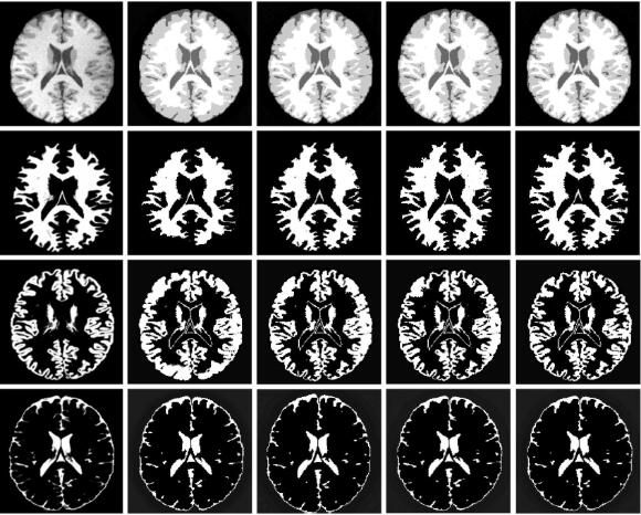 AVLSM: Adaptive Variational Level Set Model for Image Segmentation in the Presence of Severe Intensity Inhomogeneity and High Noise